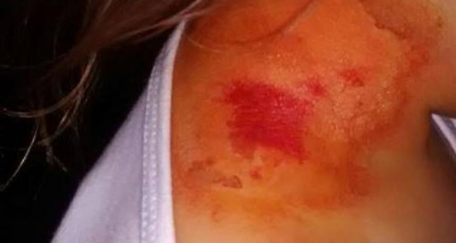 Alerta por las dermatitis que provoca  el Paederus o “latigazo”