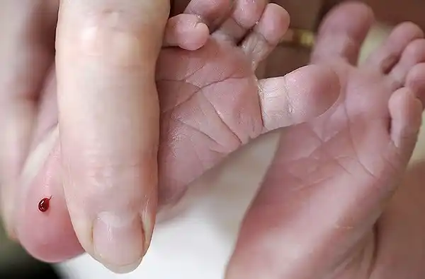 Realizan screening neonatal para detectar la fibrosis quística