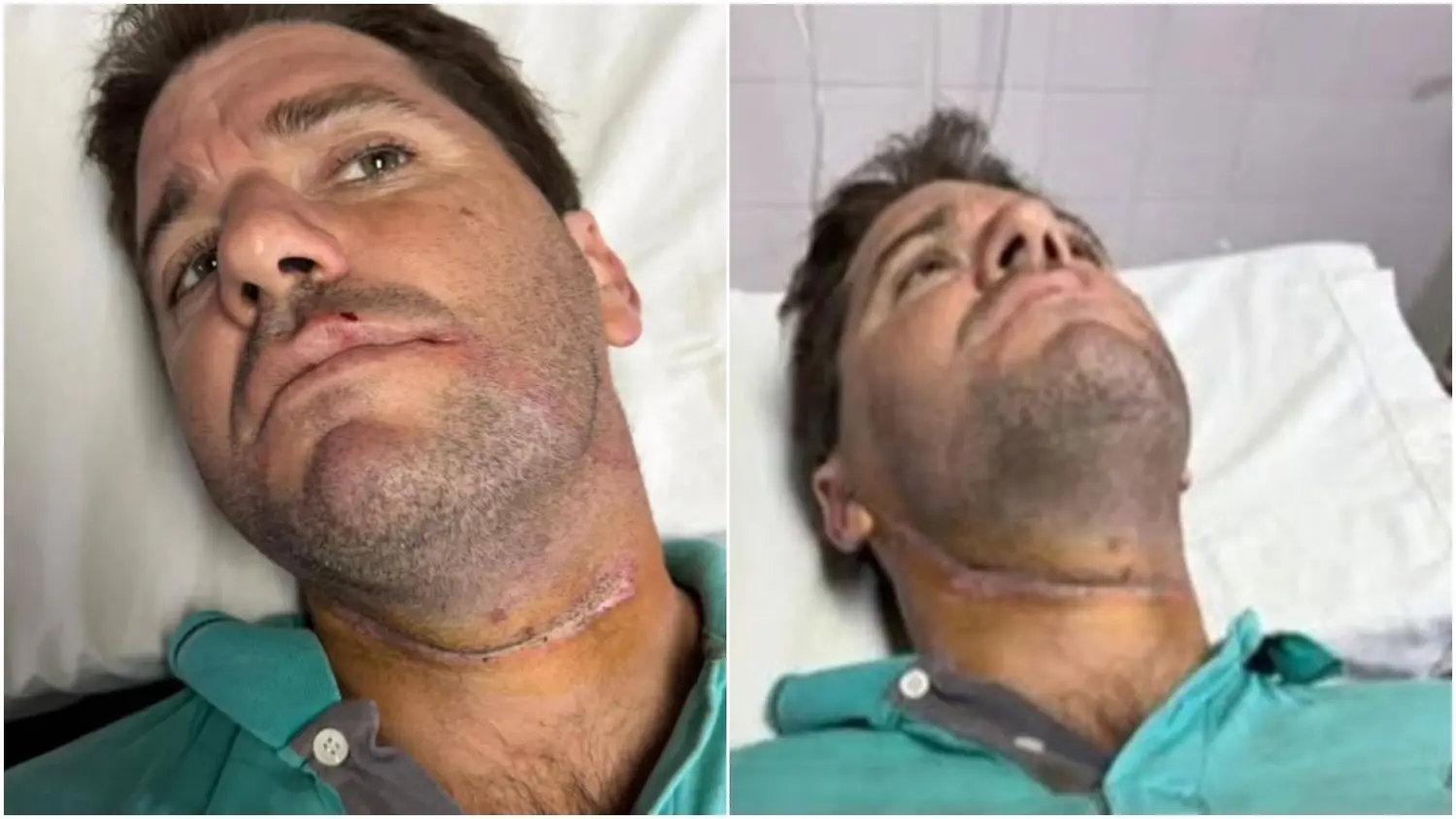 Un motociclista se enredó con un cable suelto y casi muere "decapitado" en Carlos Casares: "Pensé que no la contaba"