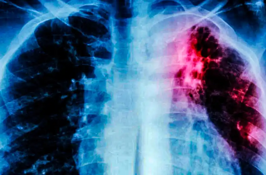 Tuberculosis en Mar del Plata: "Es una enfermedad infectocontagiosa que nunca ha dejado de existir"