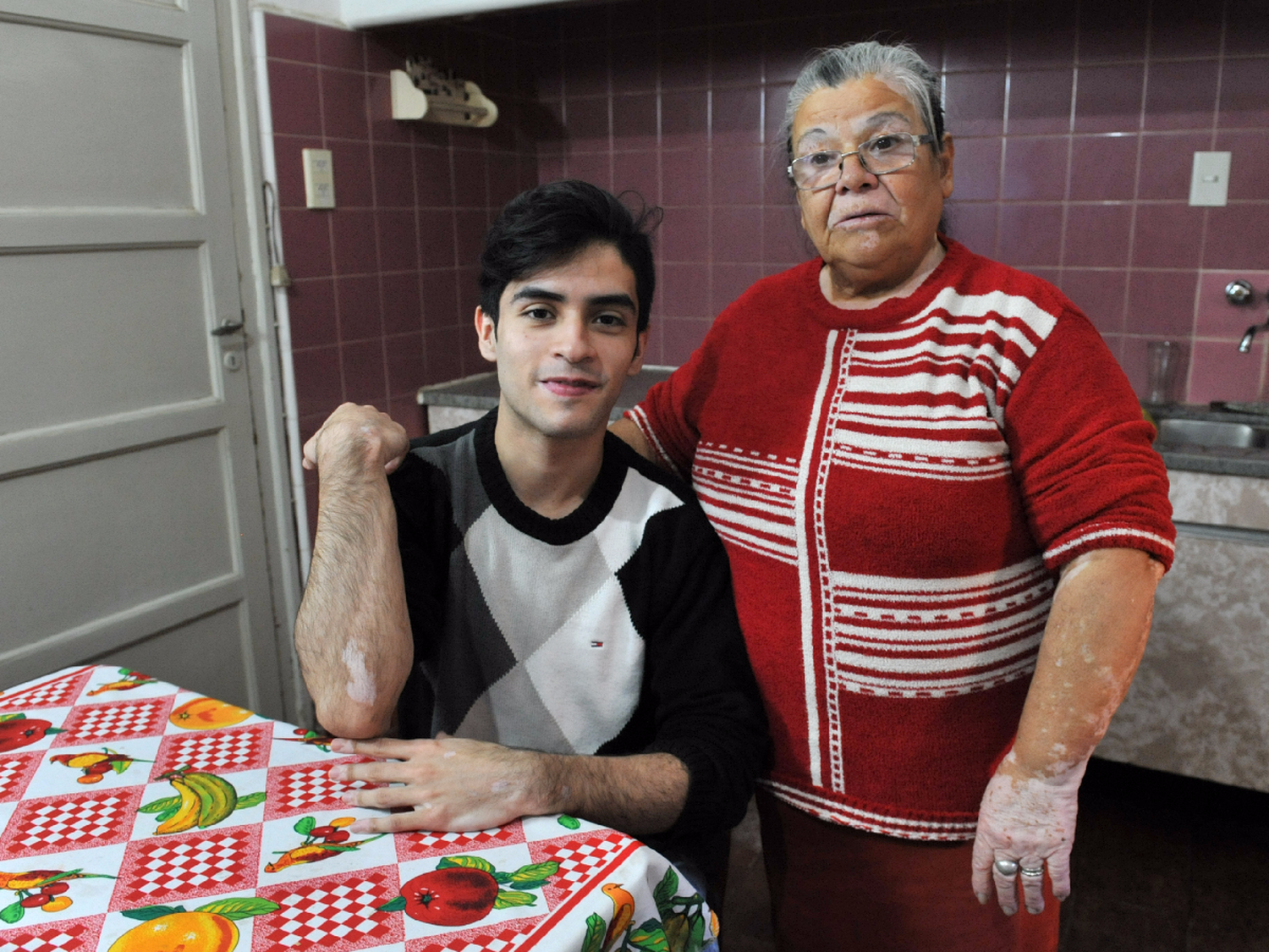 Abuela y nieto enfrentan la vida con vitiligo