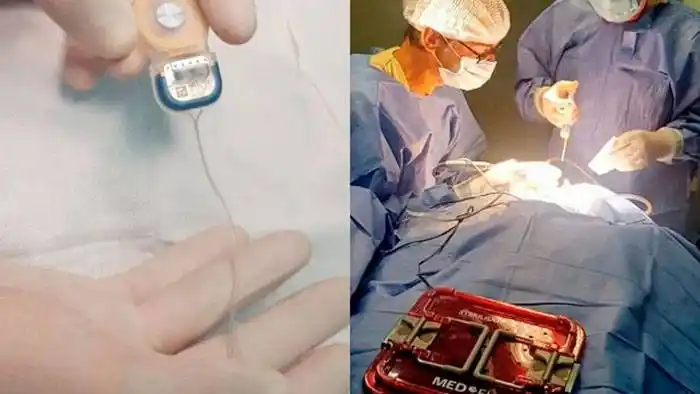 Un nuevo modelo de implante le permitirá volver a escuchar a dos personas en San Luis