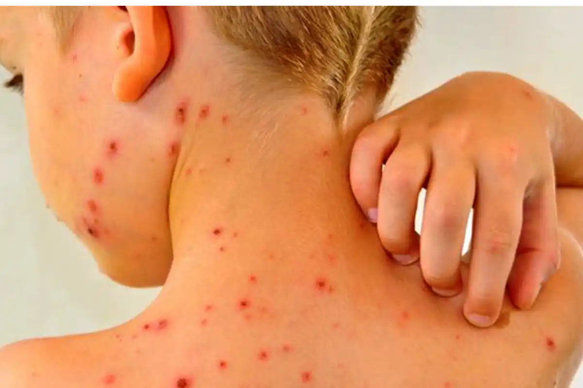 Formosa refuerza la barrera sanitaria ante la amenaza del sarampión