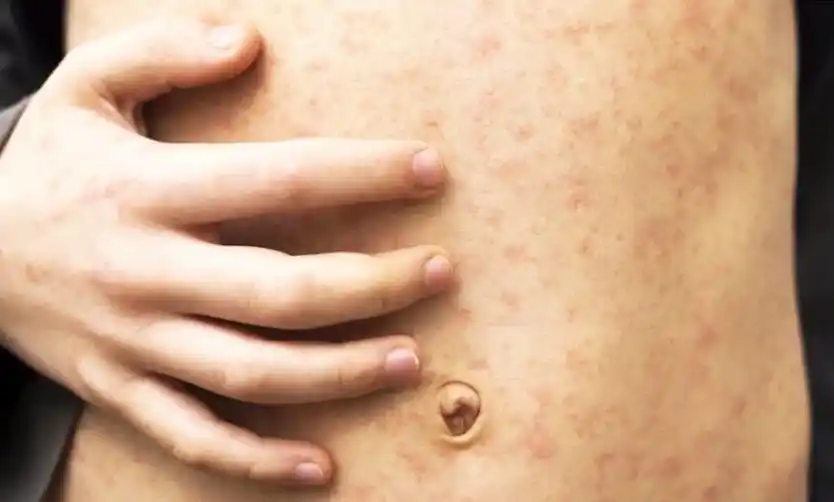 Sarampión: siguen creciendo los contagios en el AMBA