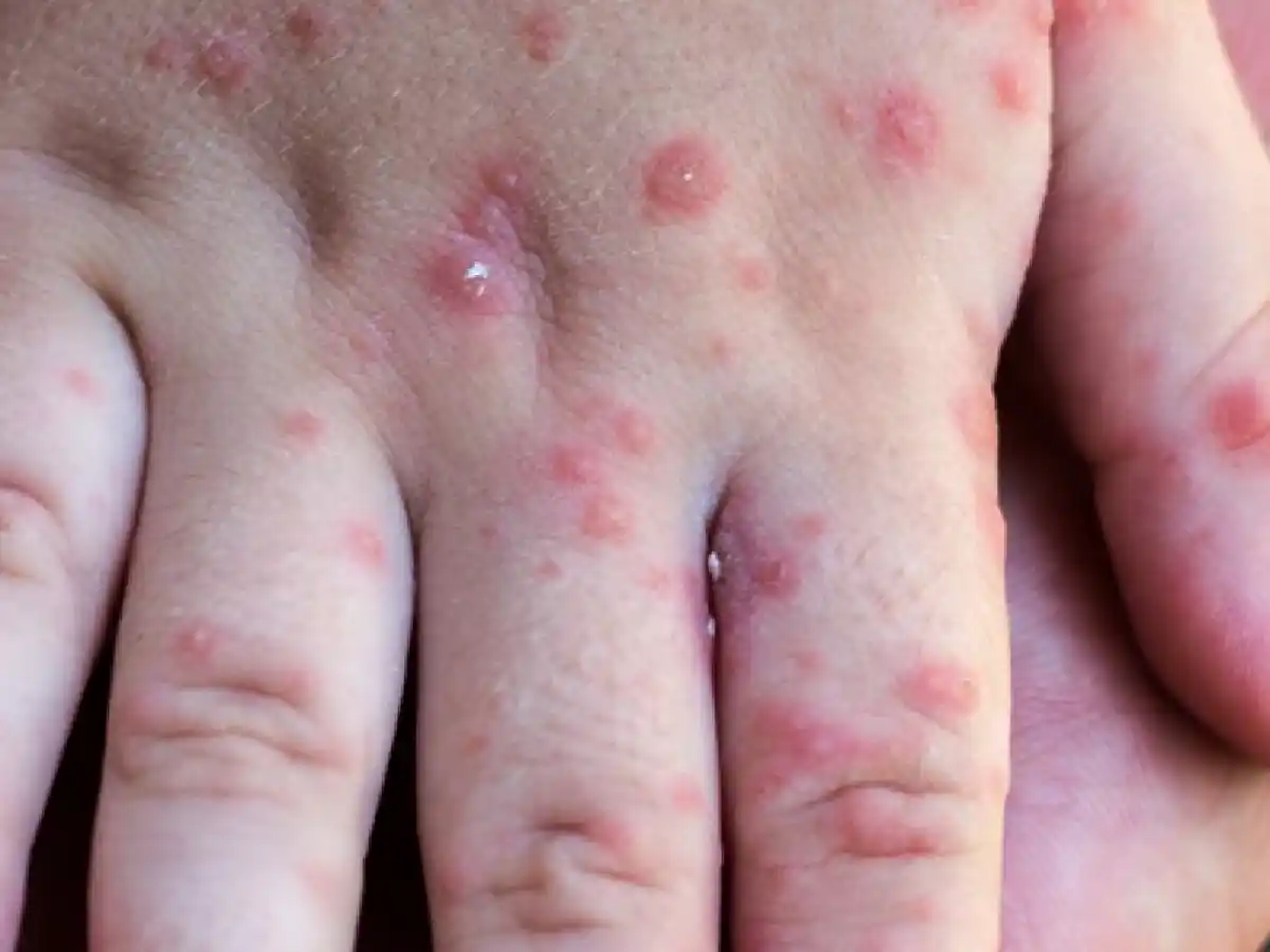 Viruela del Mono: en una semana se triplicaron los casos en todo el mundo