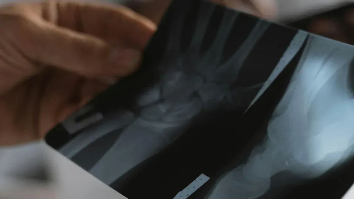 Podría aplicarse tanto en fracturas simples como en aquellas más complicadas.