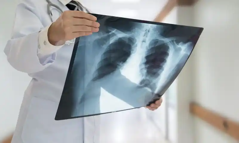 Tuberculosis: advierten sobre el aumento de casos en Gualeguaychú al igual que en el resto del país
