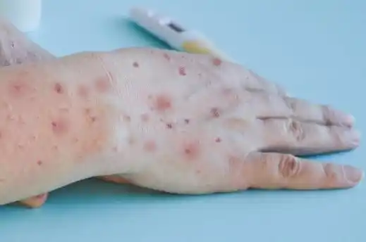 La viruela símica es parte de los consejos de prevención que impartió el Ministerio de Salud a todos los municipios.