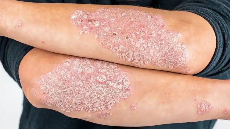 Psoriasis: la importancia de su detección temprana 