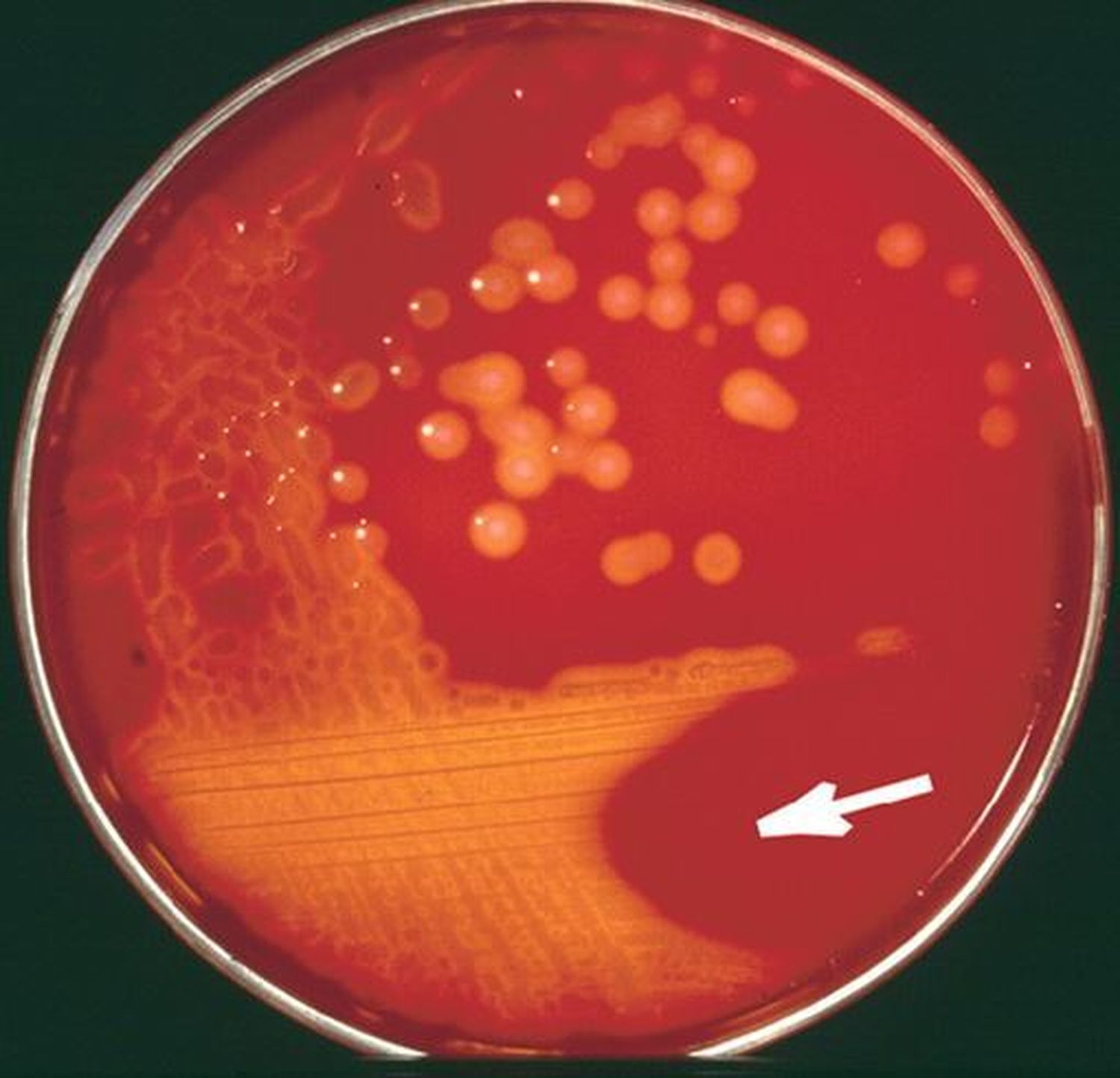 Streptococcus pyogenes, enemiga silenciosa