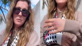 ani La Chepi relató el accidente que sufrió al intentar separar a su perra de una pelea con otros perros