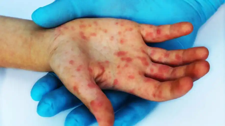 Sarampión en Argentina: La ONU había advertido una suba de casos mundiales de un 79%