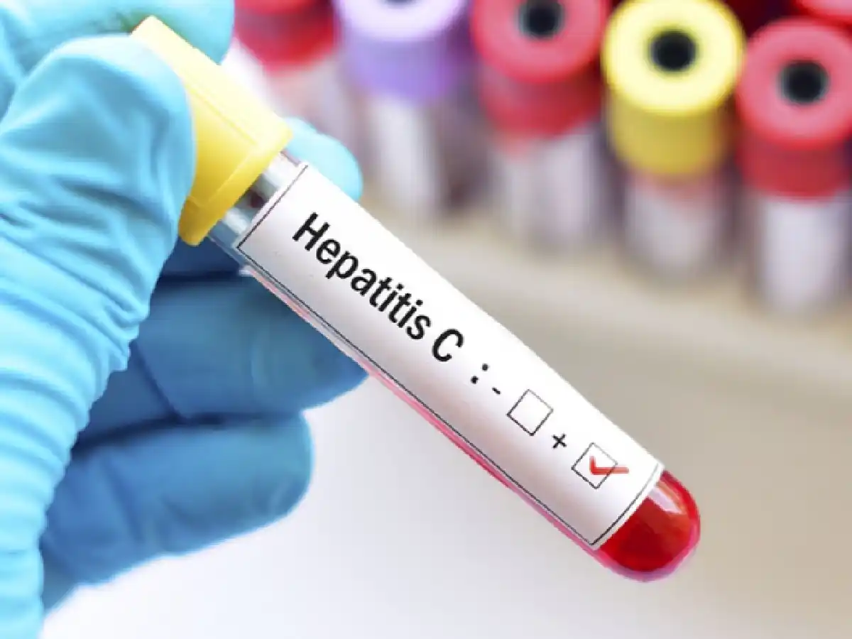 Solo el 18% quienes son diagnosticados con hepatitis  B y C realizan el tratamiento