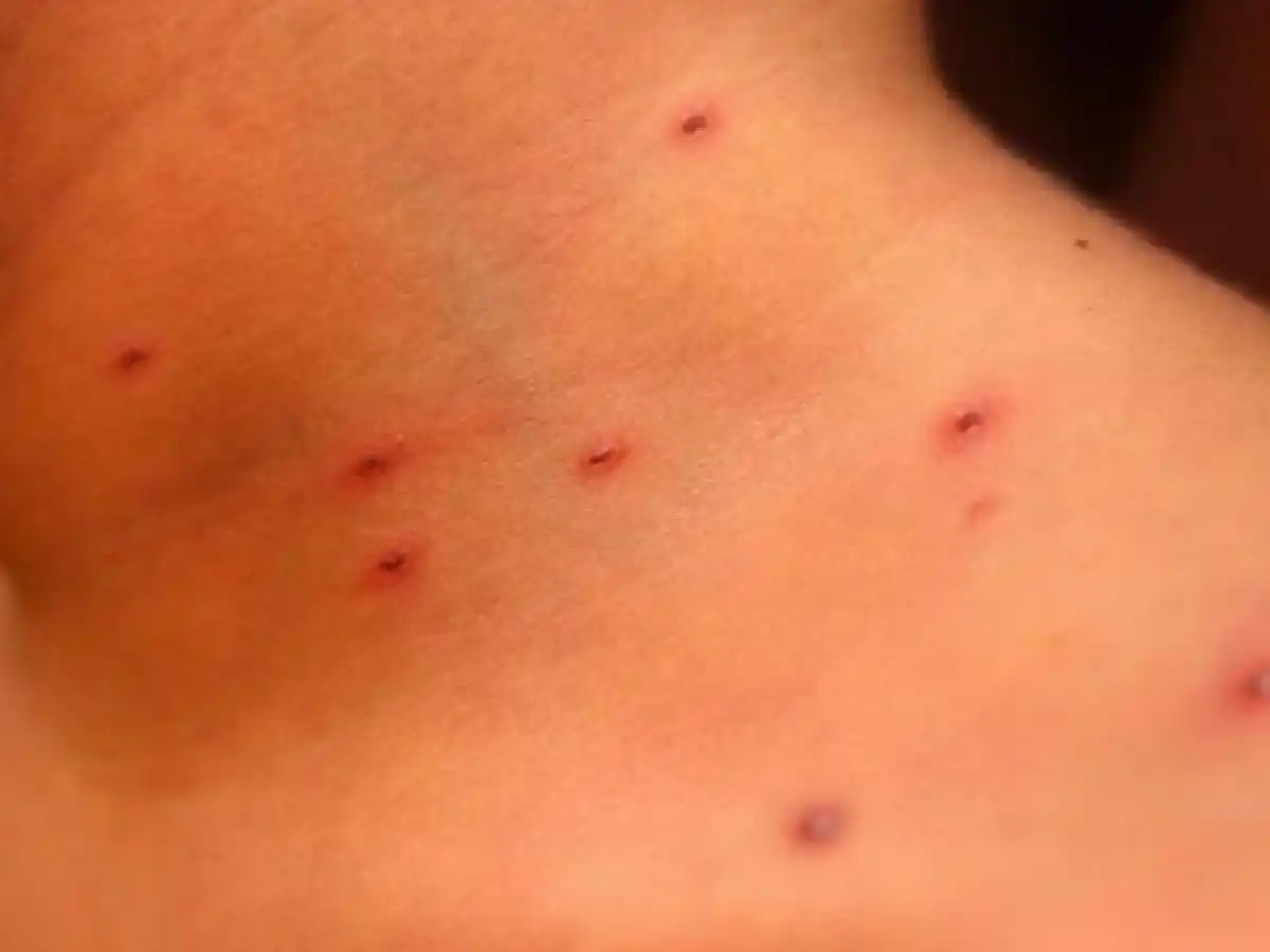 Se registró un caso de sarampión en Rosario