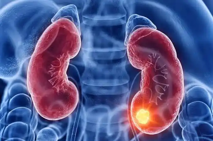 El 90% de los tumores malignos de riñón corresponden al carcinoma de células renales.