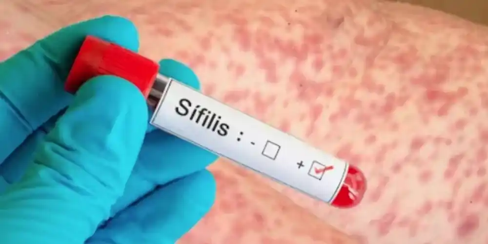 La sífilis es un enfermedad de transmisión sexual.