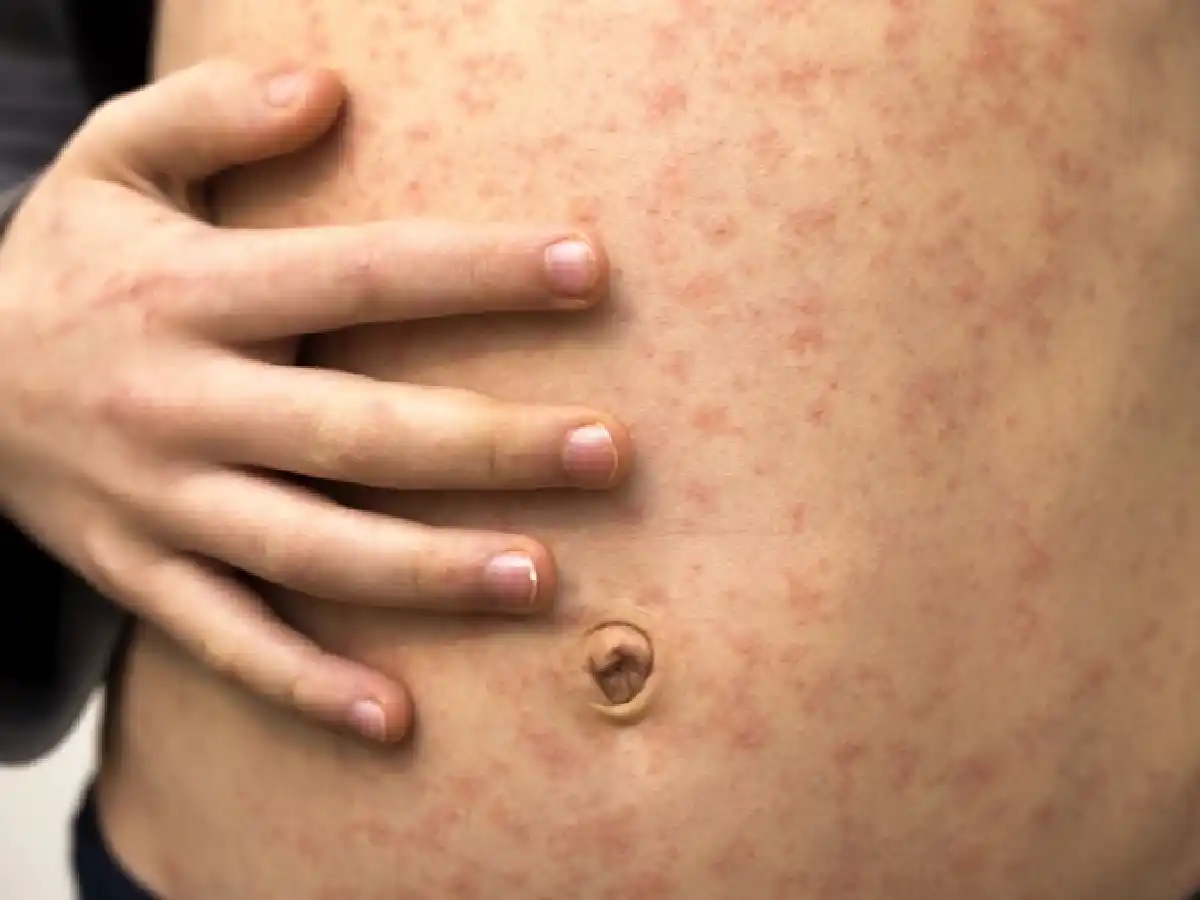 Al menos 713 mil niños son susceptibles al sarampión, rubéola y paperas