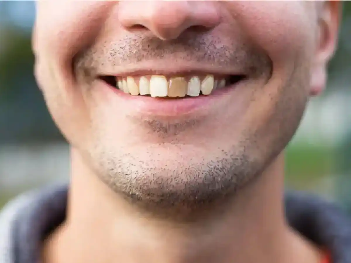 ¿Qué es un diente muerto?   