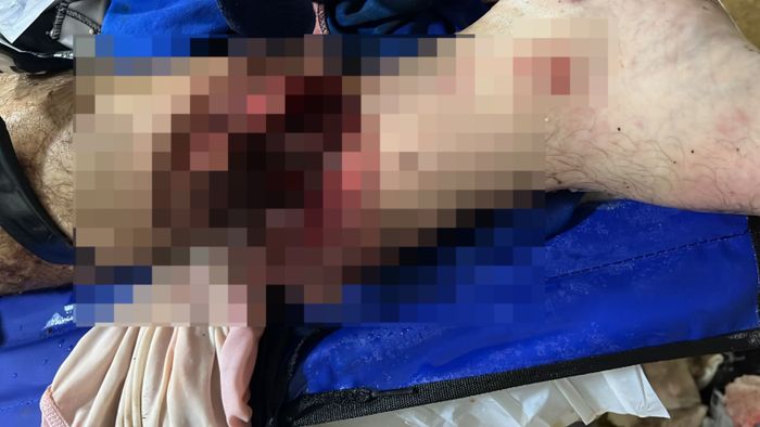 Horror en el FONAVI: Un hombre atacó´a machetazos a un adolescente y le cortó una pierna