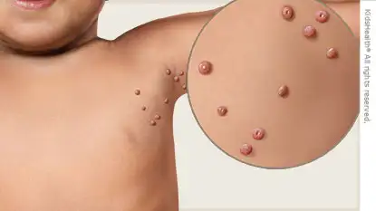 Moluscos contagiosos, frecuentes en chicos de más de un año.