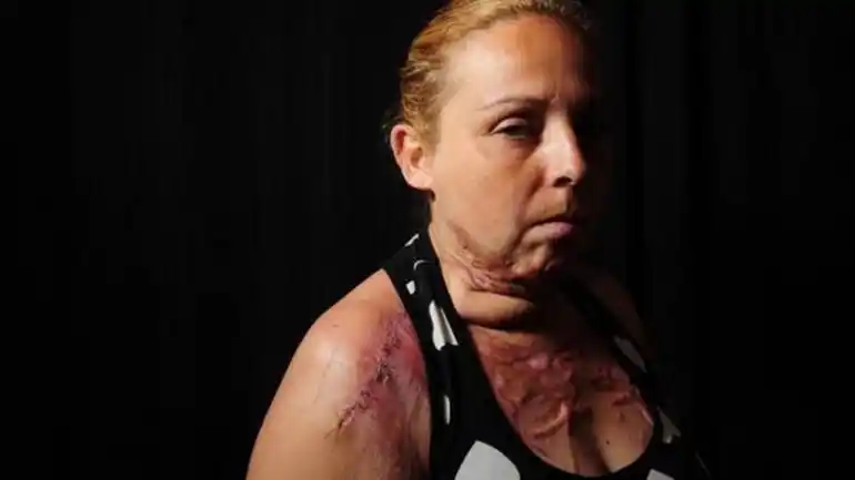 Su marido la quemó viva, ella sobrevivió y él sigue amenazándola