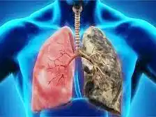 Ocho de cada diez argentinos con Enfermedad Pulmonar Obstructiva Crónica no están diagnosticados