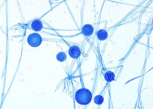 Primera muerte en Argentina por "Hongo negro" asociado a Covid-19: La víctima estaba internada en Lomas de Zamora