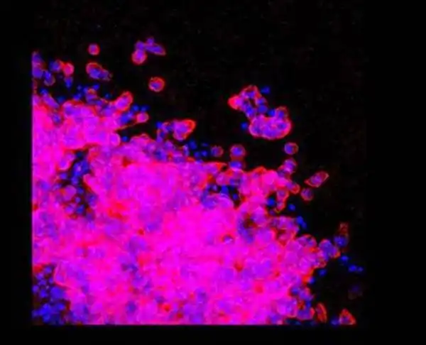 Identifican las células clave en la  metástasis del melanoma