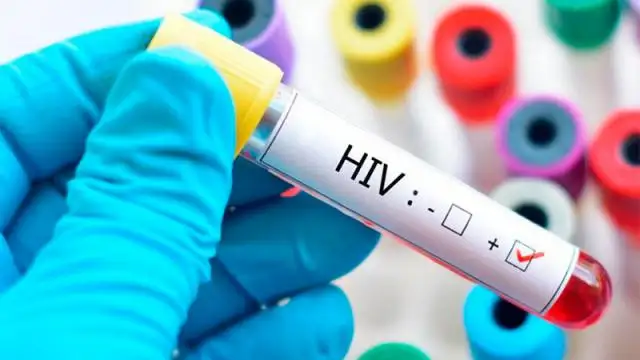 Hallaron una fórmula para eliminar del organismo las células infectadas con HIV