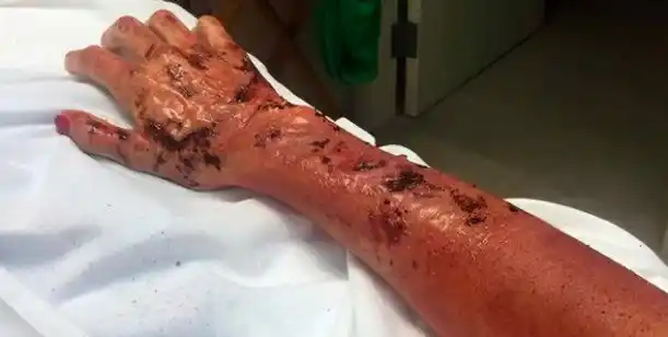 Así le quedó la mano a Juana Viale