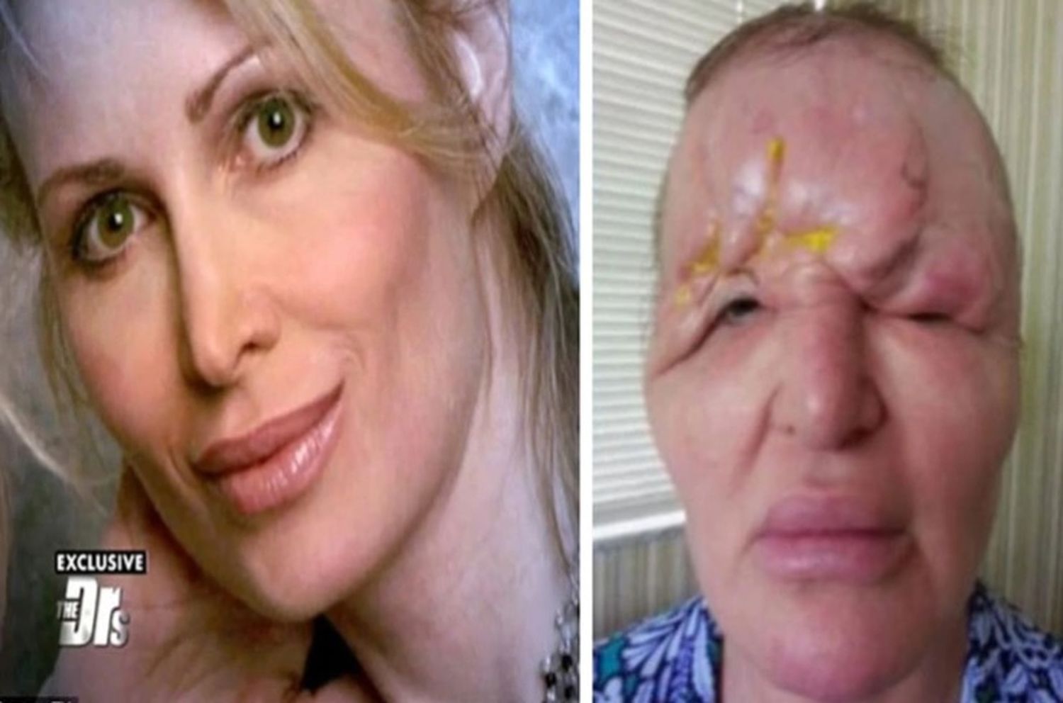 La cirugía que terminó con la increíble belleza de Carol Bryan