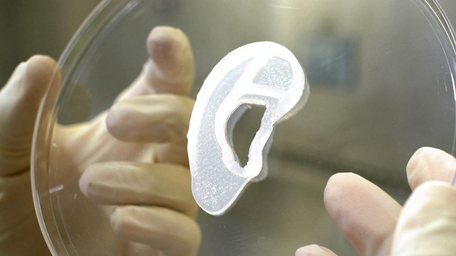 Trasplantaron por primera vez una oreja 3D hecha con células humanas