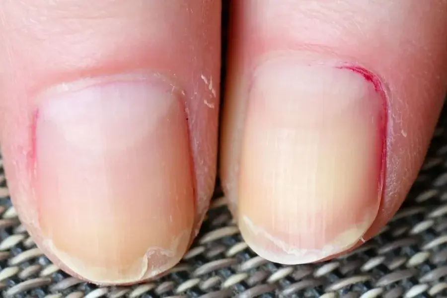 Uñas descamadas: por qué ocurre y qué dicen sobre tu salud