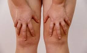¿TIENES GRASA EN LAS PIERNAS? Te contamos cómo rebajarlas