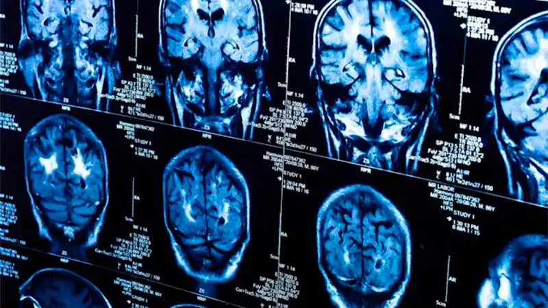 El Covid produce reducción de materia gris en cerebro: las áreas más afectadas