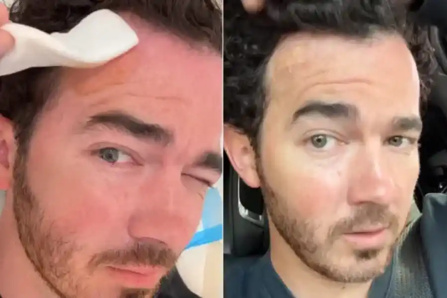 Uno de los Jonas Brothers contó que sufre cáncer de piel y recomendó "revisarse los lunares"