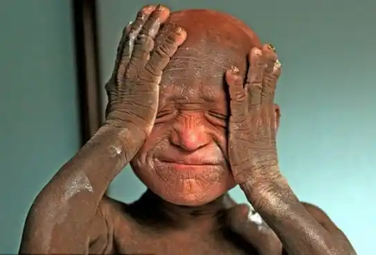 La extraña enfermedad que vuelve de "piedra" a un pequeño 