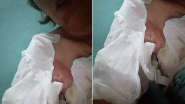 Mujer quemada minimizó los hechos y declaró que ella se arrojó el alcohol