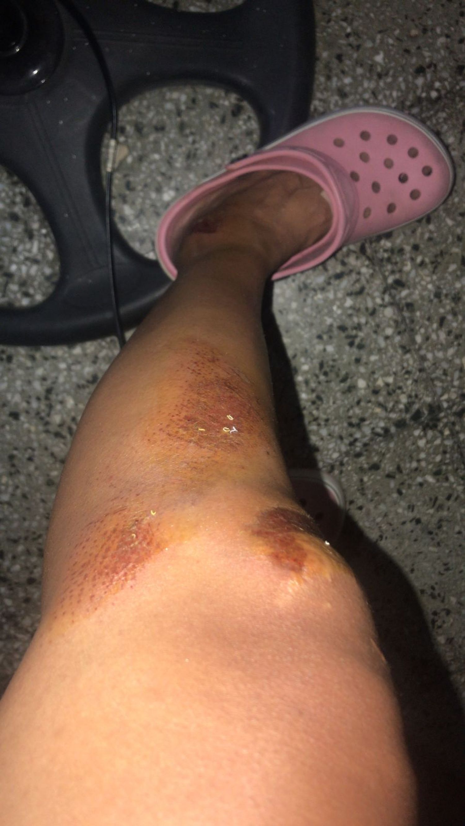 lesiones asaltada moto las heras