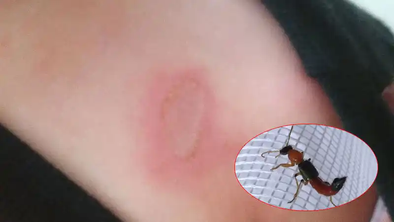 Preocupa la aparición de un insecto que produce dermatitis