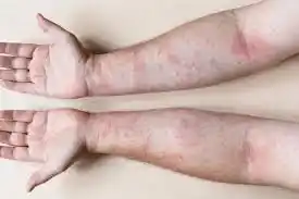 El lupus es una de las enfermedades autoinmunes y como tal sus síntomas son variados.