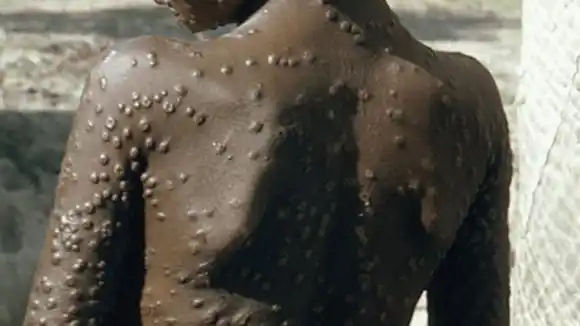 VIRUELA DEL MONO MATA A 548 en el Congo y Suecia reporta un primer caso