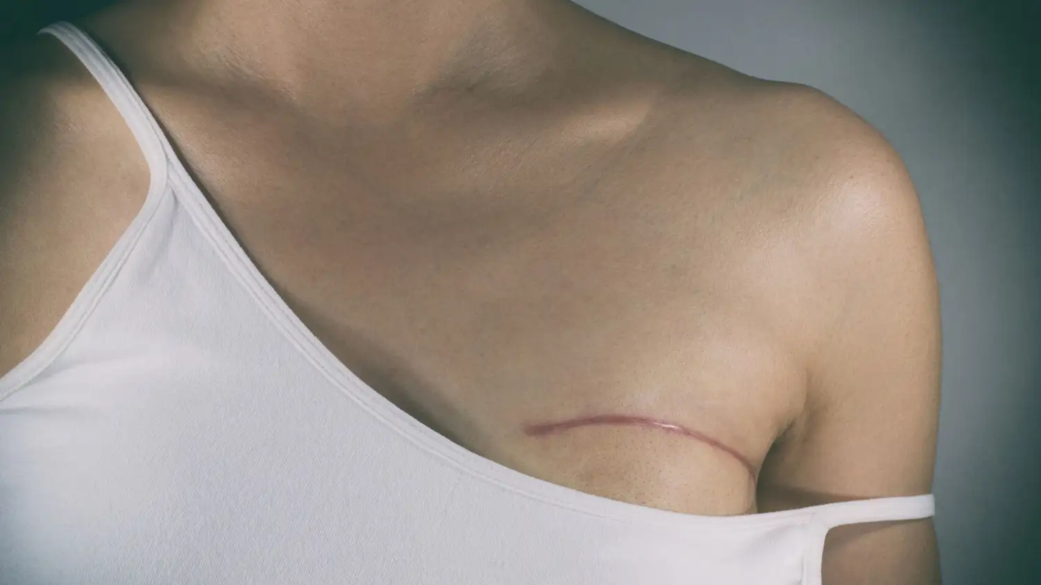Cáncer de Mama: Las estadísticas no han variado y la forma más eficiente de prevención es la detección temprana