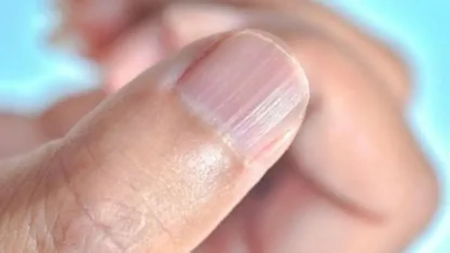 ¿Por qué aparecen rayas en las uñas?
