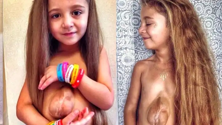 El extraño caso de la nena que nació con el corazón fuera del pecho