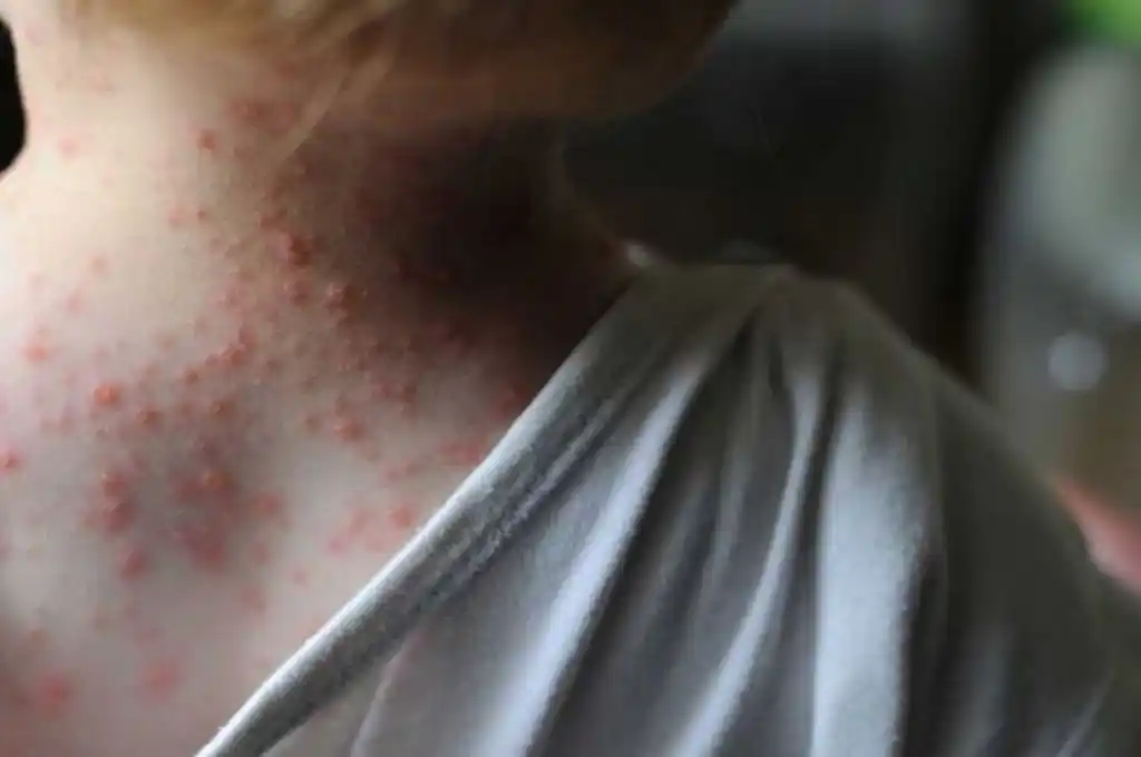 Alerta: confirmaron el primer caso de viruela del mono en Argentina