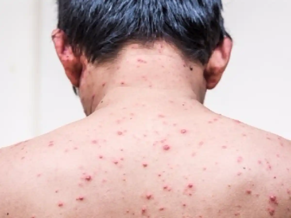 Alerta sarampión: confirmaron un nuevo caso en un hombre de Rosario