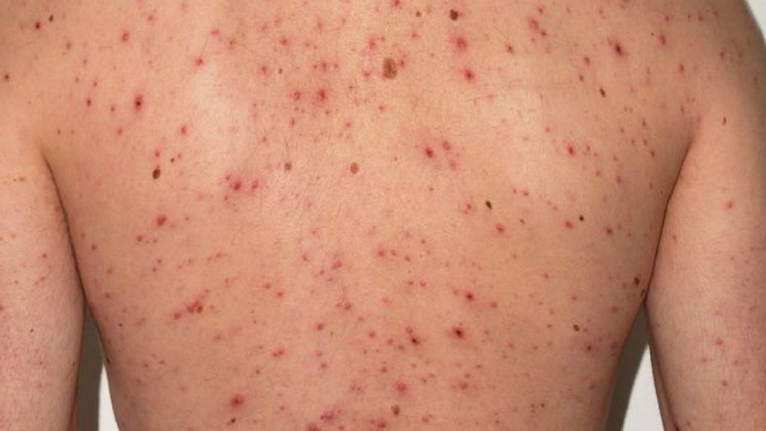 Alerta epidemiológico por un caso de sarampión en Rosario