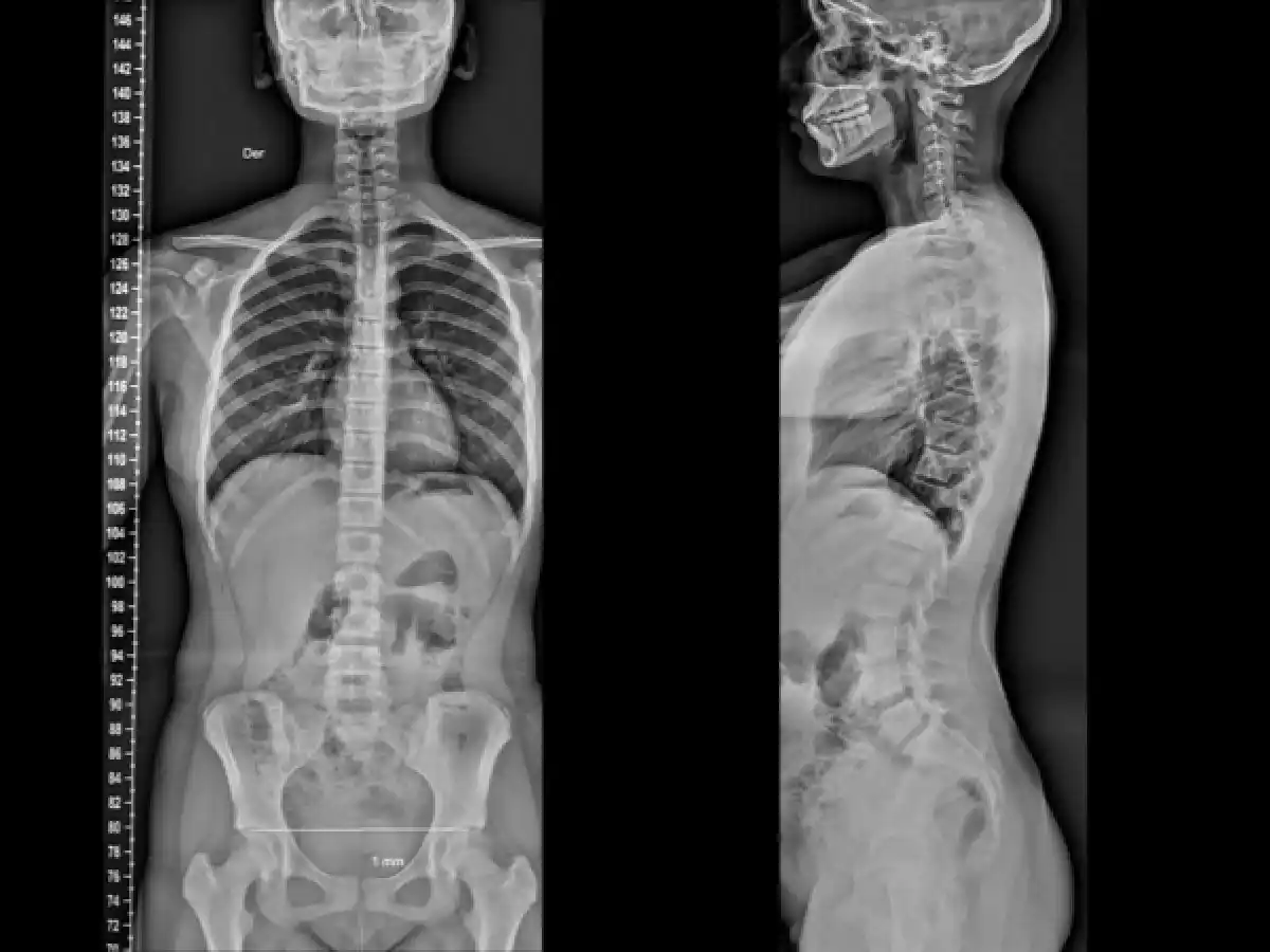 El uso del celular modificó el esqueleto humano