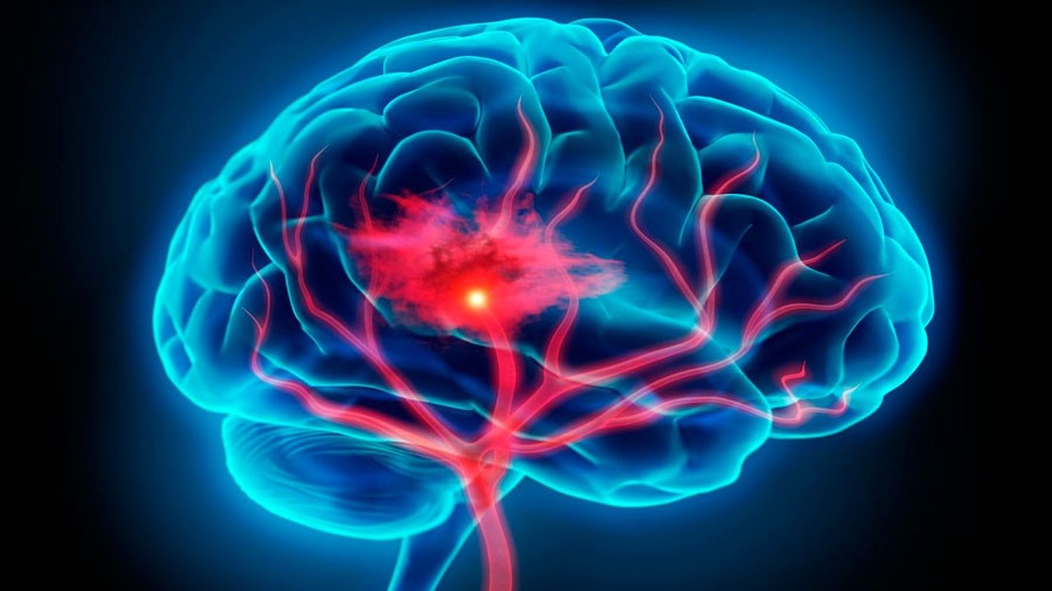 ACV y demencia, las enfermedades que más afectan al cerebro